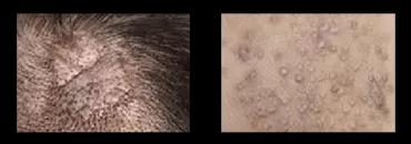 皮肤病为何治愈困难？（探究皮肤病难以治愈的原因及解决方法）