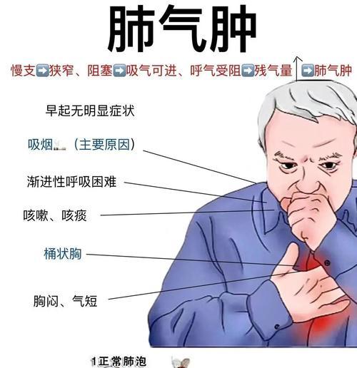 狗狗肺气肿（了解狗狗肺气肿的常见表现及其处理方法）